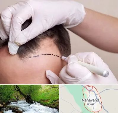 کاشت مو به روش SUT در نهاوند