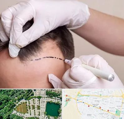 کاشت مو به روش SUT در وکیل آباد مشهد 