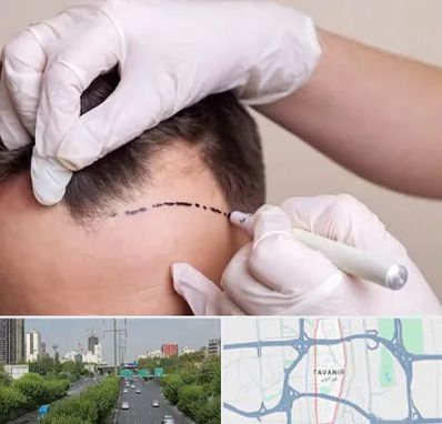 کاشت مو به روش SUT در توانیر