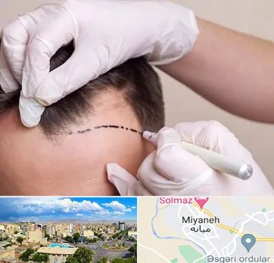 کاشت مو به روش SUT در میانه