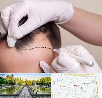 کاشت مو به روش SUT در سرسبز 