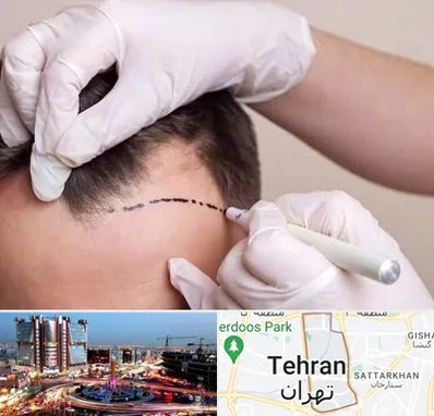 کاشت مو به روش SUT در صادقیه 