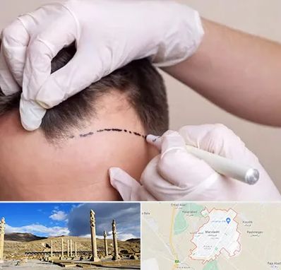 کاشت مو به روش SUT در مرودشت