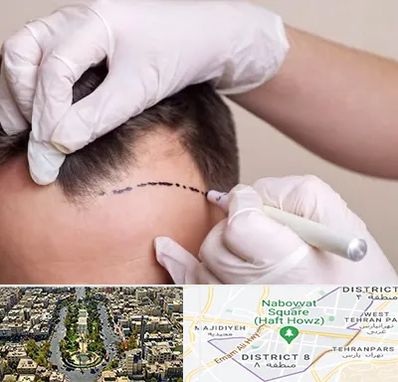 کاشت مو به روش SUT در نارمک 