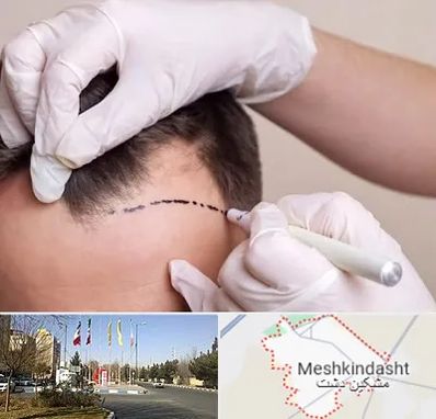 کاشت مو به روش SUT در مشکین دشت