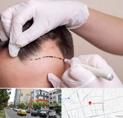 کاشت مو به روش SUT در هفده شهریور تبریز