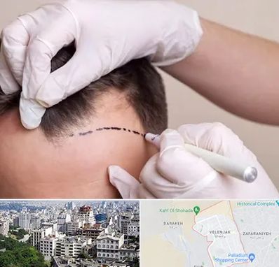 کاشت مو به روش SUT در ولنجک 