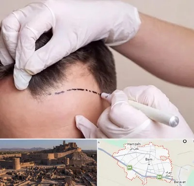 کاشت مو به روش SUT در بم
