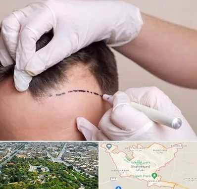 کاشت مو به روش SUT در شهرکرد