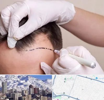 کاشت مو به روش SUT در ازگل