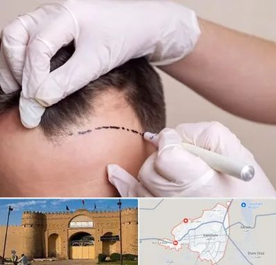 کاشت مو به روش SUT در ایرانشهر