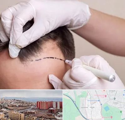 کاشت مو به روش SUT در سهند تبریز