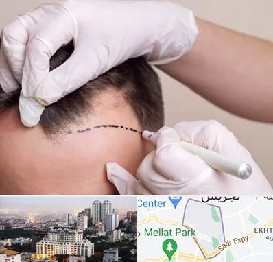 کاشت مو به روش SUT در الهیه 