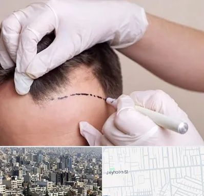 کاشت مو به روش SUT در جیحون