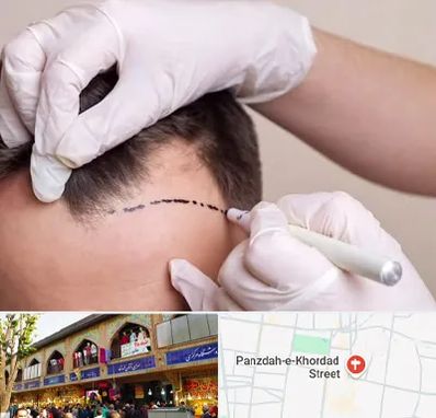 کاشت مو به روش SUT در 15 خرداد