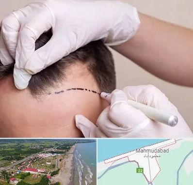 کاشت مو به روش SUT در محمودآباد
