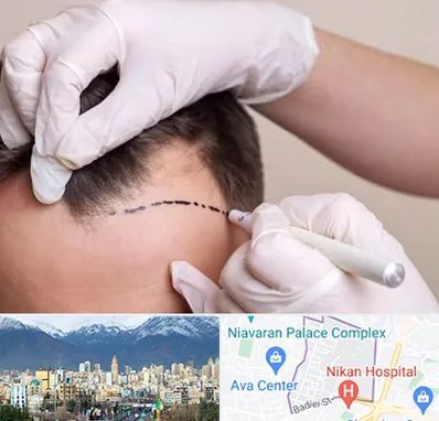 کاشت مو به روش SUT در آجودانیه 