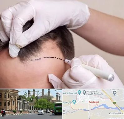 کاشت مو به روش SUT در پاکدشت