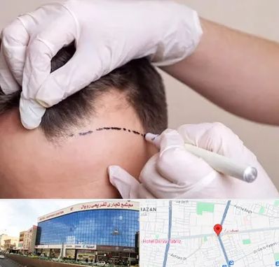 کاشت مو به روش SUT در نصف راه تبریز