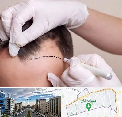 کاشت مو به روش SUT در سعادت آباد 