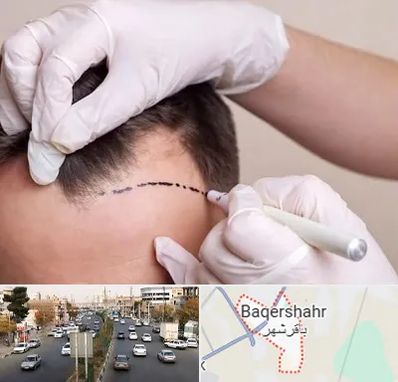 کاشت مو به روش SUT در باقرشهر