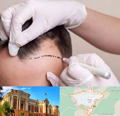 کاشت مو به روش SUT در خوی