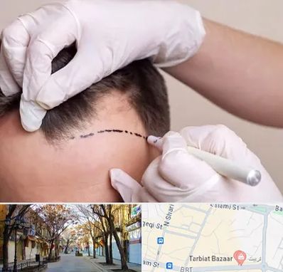 کاشت مو به روش SUT در تربیت تبریز