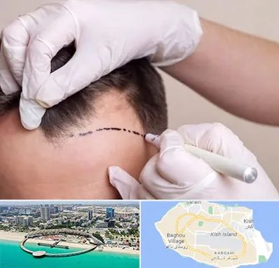 کاشت مو به روش SUT در کیش
