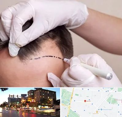 کاشت مو به روش SUT در بلوار سجاد مشهد 