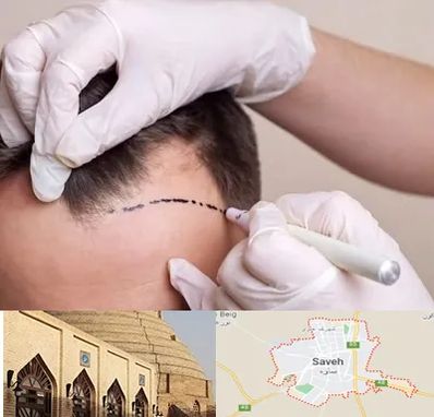 کاشت مو به روش SUT در ساوه