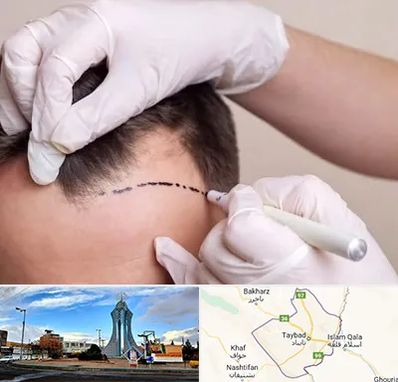کاشت مو به روش SUT در تایباد