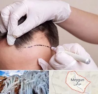 کاشت مو به روش SUT در میگون