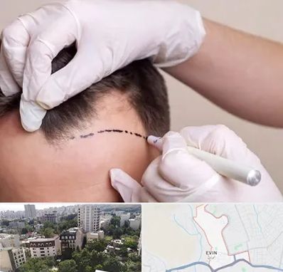 کاشت مو به روش SUT در اوین