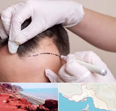 کاشت مو به روش SUT در هرمزگان