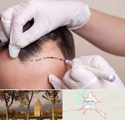 کاشت مو به روش SUT در تویسرکان