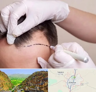 کاشت مو به روش SUT در کامیاران