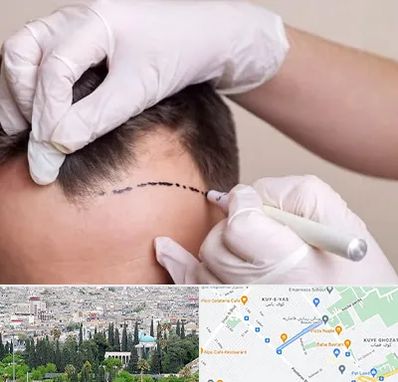 کاشت مو به روش SUT در محلاتی شیراز