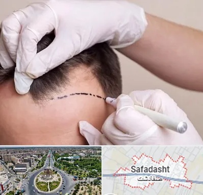 کاشت مو به روش SUT در صفادشت