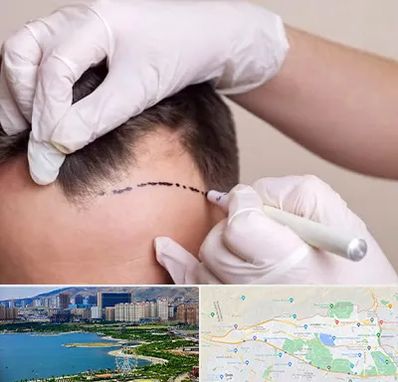 کاشت مو به روش SUT در منطقه 22 تهران 