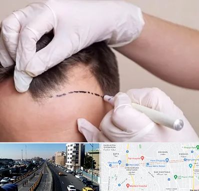 کاشت مو به روش SUT در پیروزی 