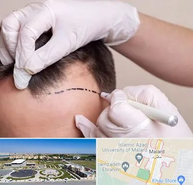 کاشت مو به روش SUT در ملارد