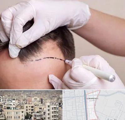 کاشت مو به روش SUT در اسکندری