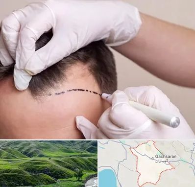 کاشت مو به روش SUT در گچساران