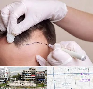 کاشت مو به روش SUT در مرکز تهران