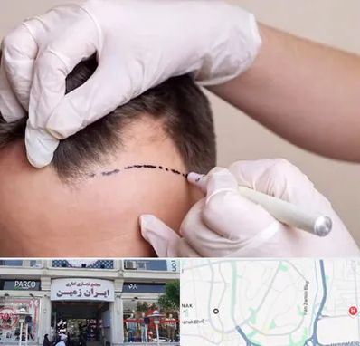 کاشت مو به روش SUT در ایران زمین