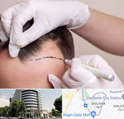 کاشت مو به روش SUT در قلهک 