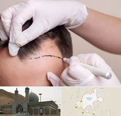 کاشت مو به روش SUT در شهرضا