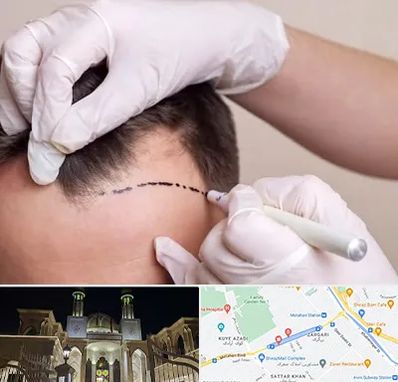کاشت مو به روش SUT در زرگری شیراز