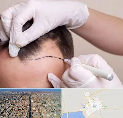 کاشت مو به روش SUT در بندر ماهشهر