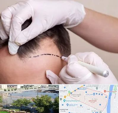 کاشت مو به روش SUT در گلستان اهواز